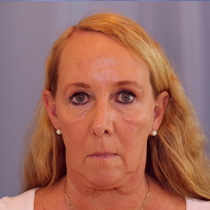 Facelift Before and After | Dr. Leslie Stevens