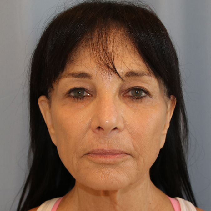 Facelift Before and After | Dr. Leslie Stevens