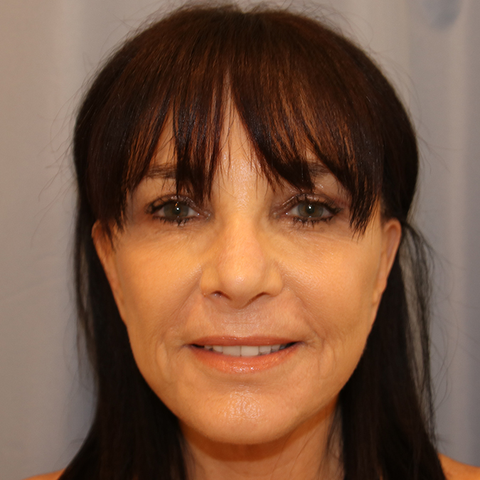Facelift Before and After | Dr. Leslie Stevens