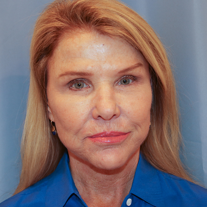 Facelift Before and After | Dr. Leslie Stevens