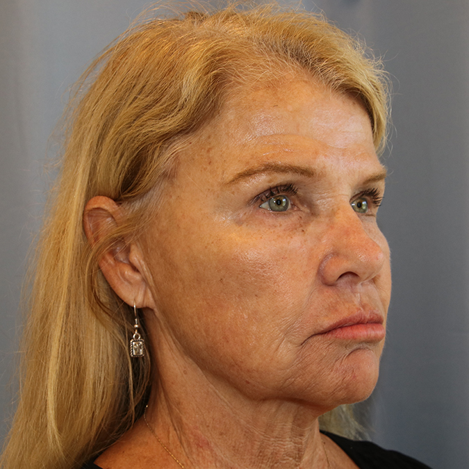 Facelift Before and After 10