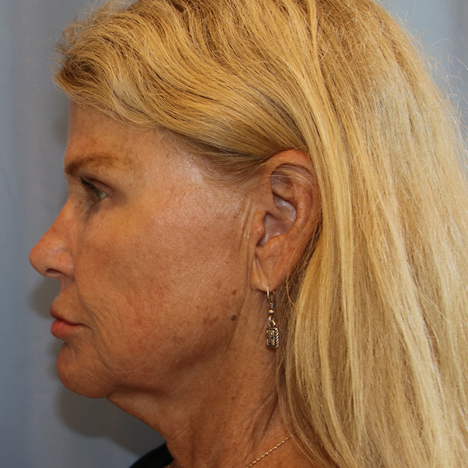 Facelift Before and After 10