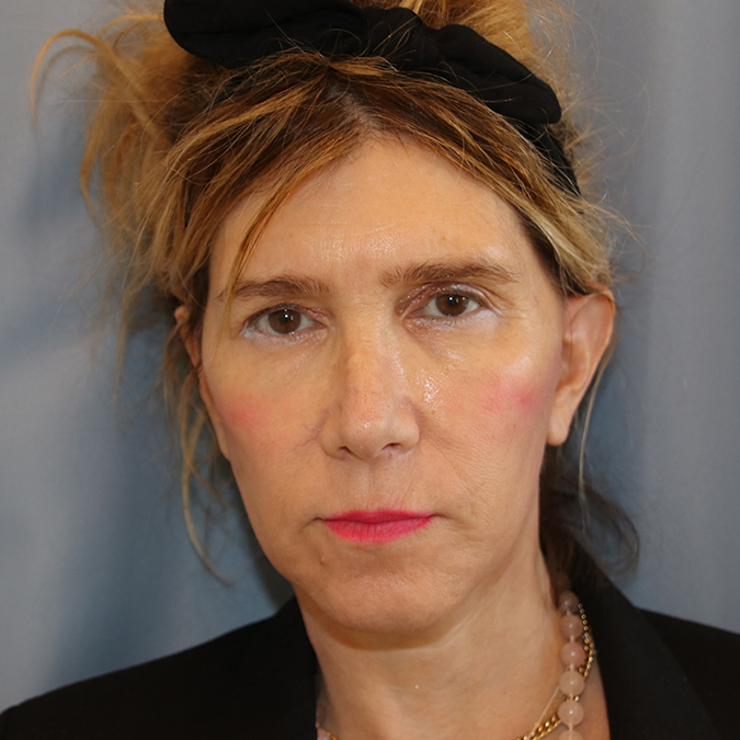 Facelift Before and After | Dr. Leslie Stevens