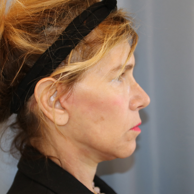 Facelift Before and After 11