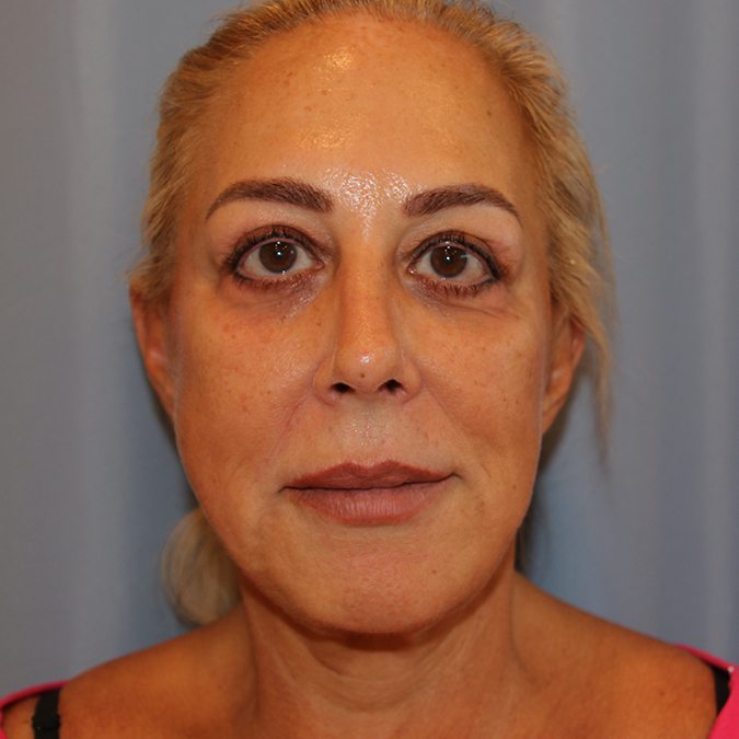 Facelift Before and After 12