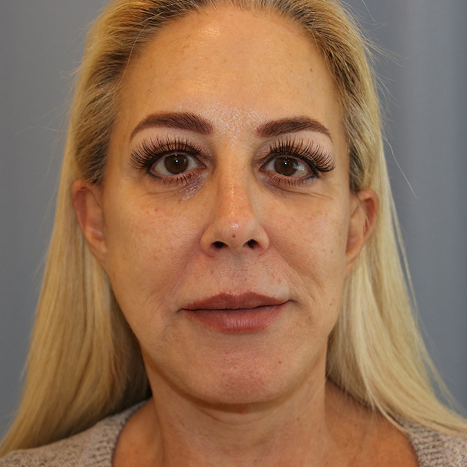 Facelift Before and After | Dr. Leslie Stevens