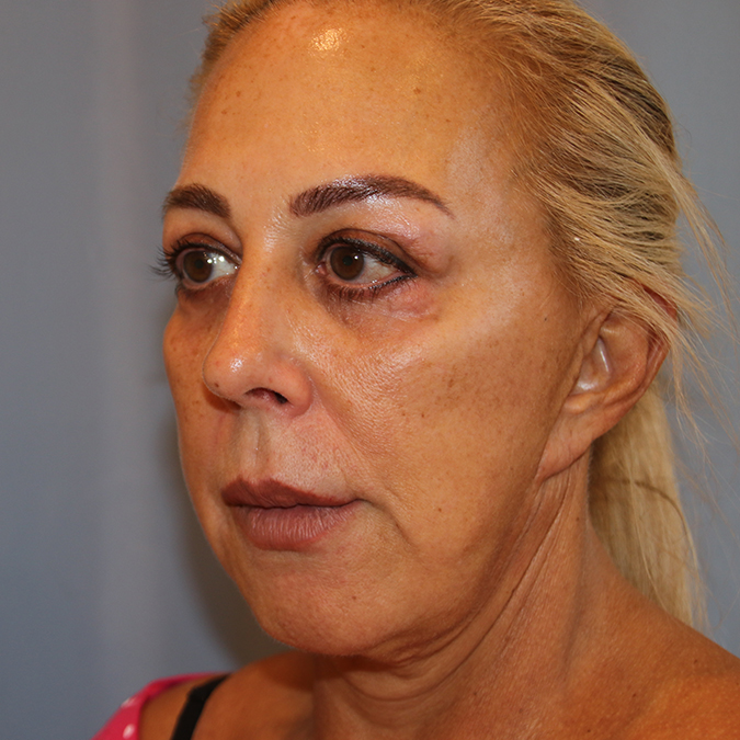 Facelift Before and After 12
