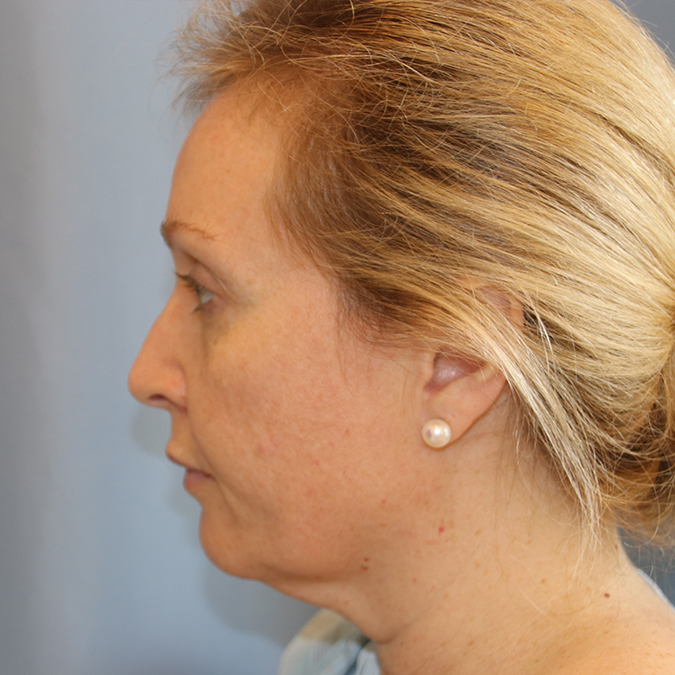 Facelift Before and After 13