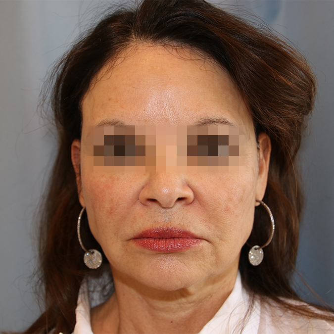 Facelift Before and After 14