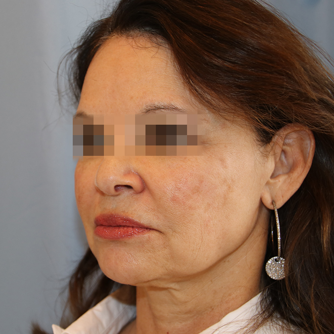 Facelift Before and After 14