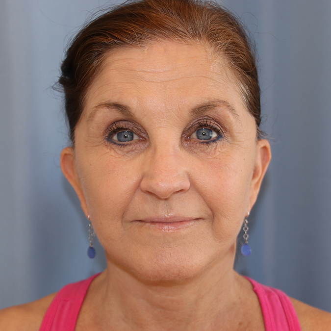 Facelift Before and After | Dr. Leslie Stevens