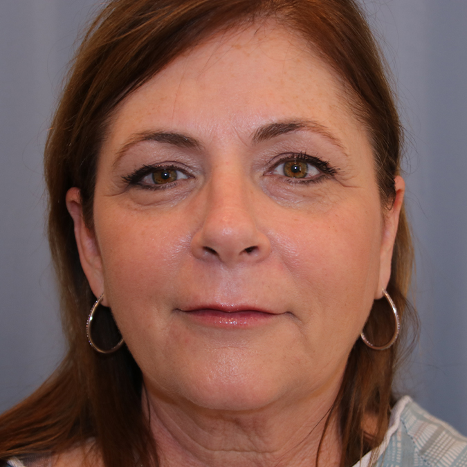 Facelift Before and After | Dr. Leslie Stevens