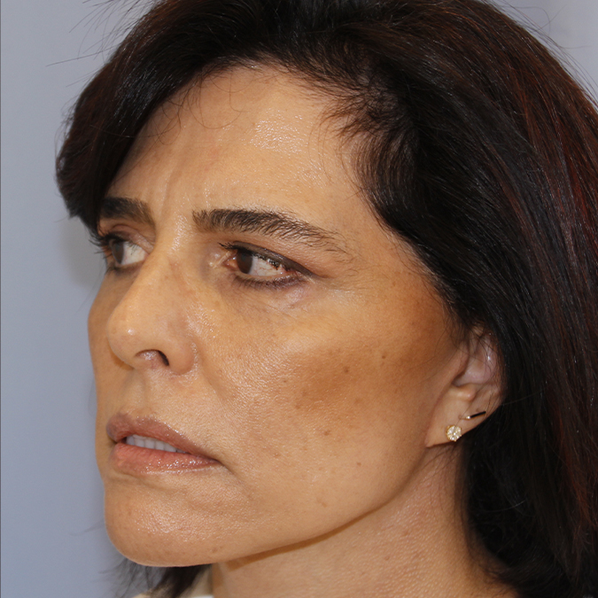 Facelift Before and After | Dr. Leslie Stevens