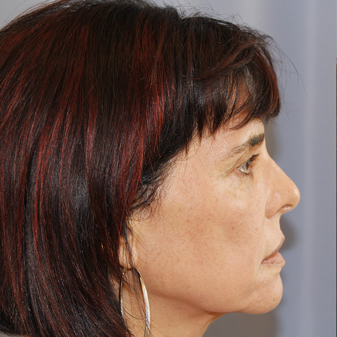 Facelift Before and After 17