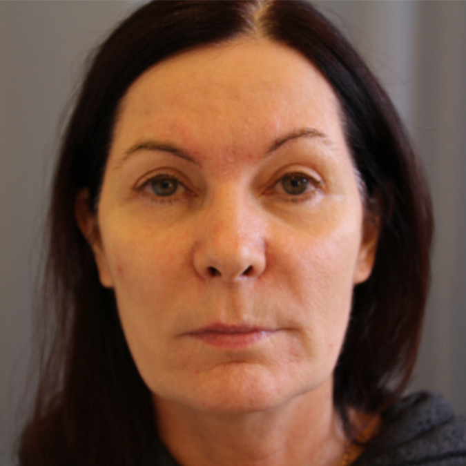 Facelift Before and After 18