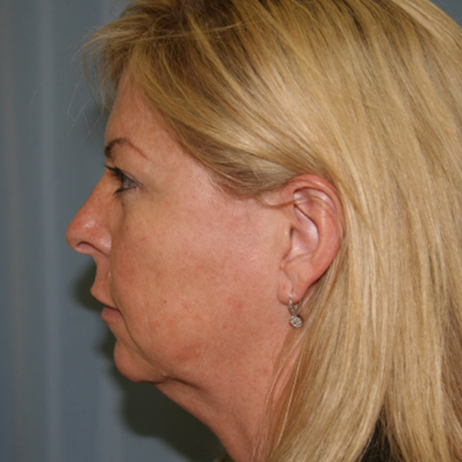 Facelift Before and After 19