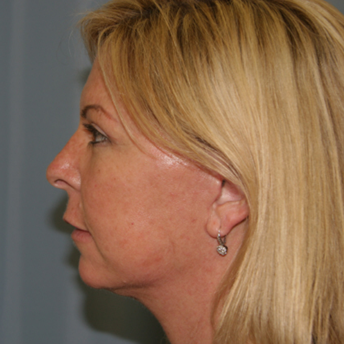 Facelift Before and After 19