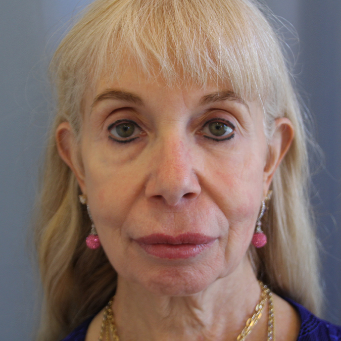 Facelift Before and After | Dr. Leslie Stevens