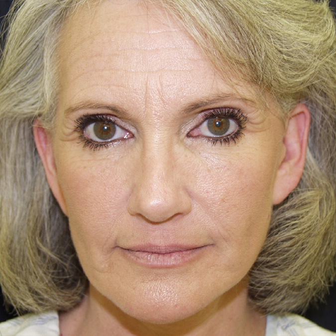 Facelift Before and After | Dr. Leslie Stevens