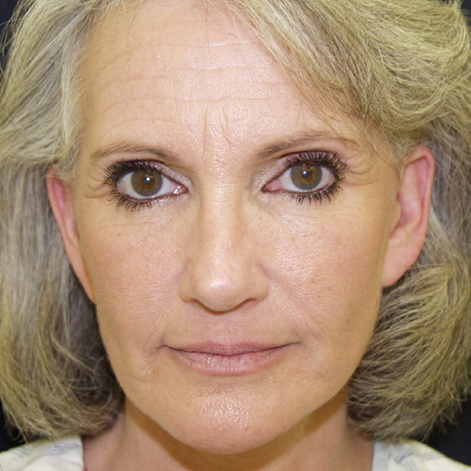 Facelift Before and After 21