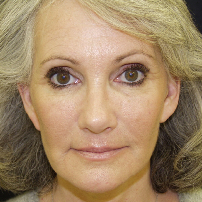 Facelift Before and After 33