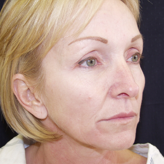 Facelift Before and After 22