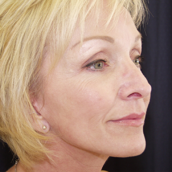 Facelift Before and After 22