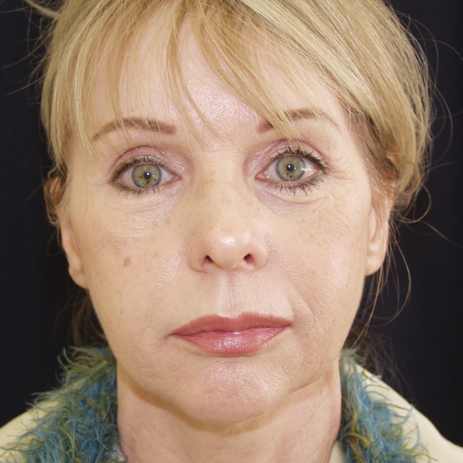 Facelift Before and After | Dr. Leslie Stevens