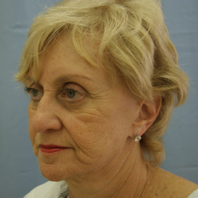 Facelift Before and After 24