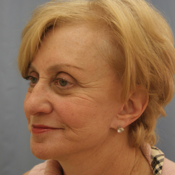 Facelift Before and After | Dr. Leslie Stevens
