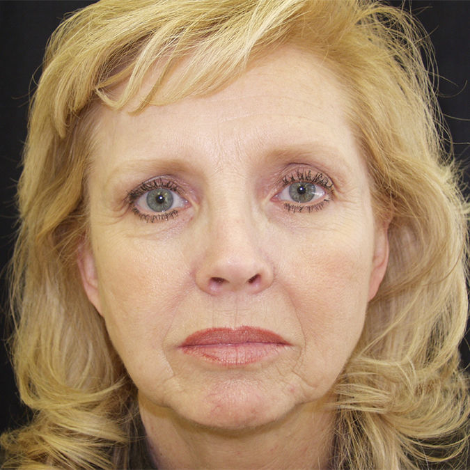 Facelift Before and After 26