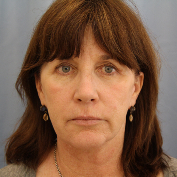 Facelift Before and After | Dr. Leslie Stevens