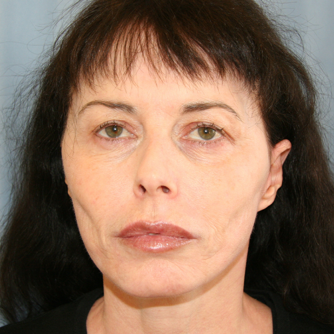 Facelift Before and After | Dr. Leslie Stevens