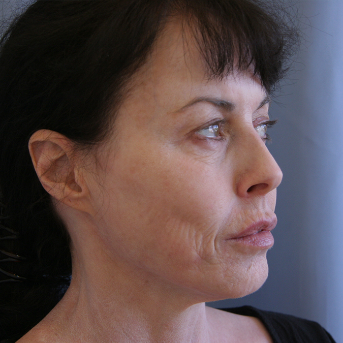 Facelift Before and After 29