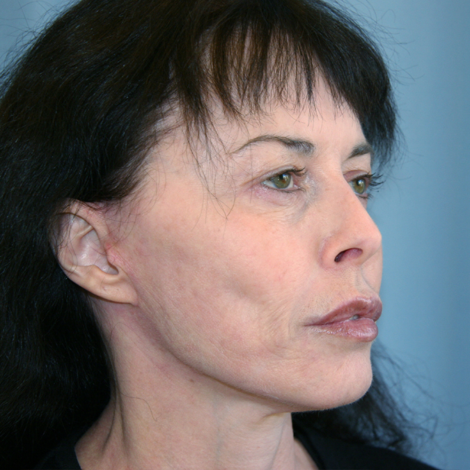 Facelift Before and After 29
