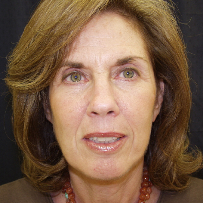 Facelift Before and After | Dr. Leslie Stevens
