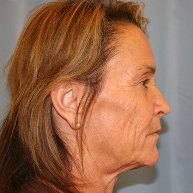 Facelift Before and After 31