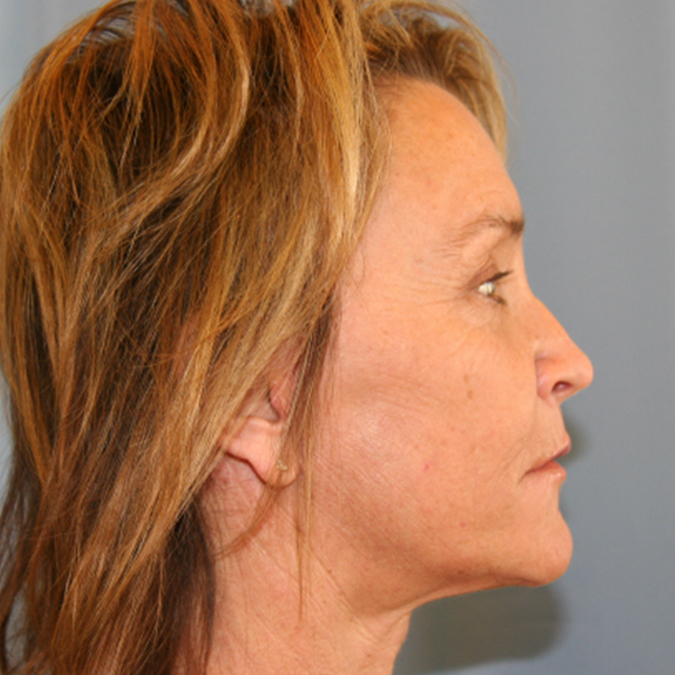 Facelift Before and After 31