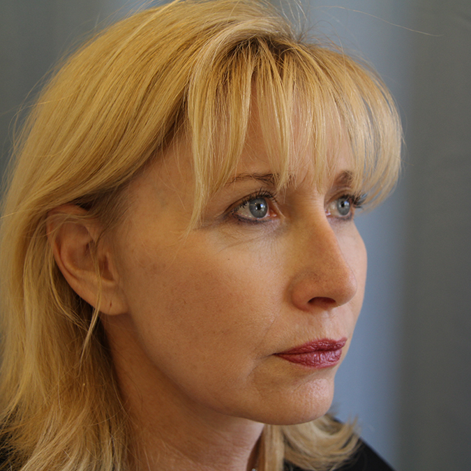 Facelift Before and After | Dr. Leslie Stevens