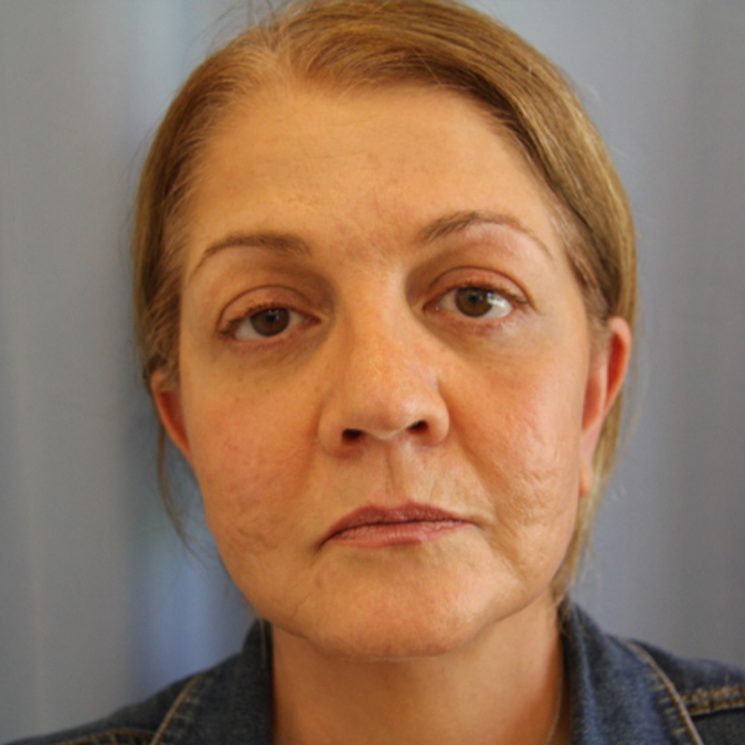 Facelift Before and After | Dr. Leslie Stevens
