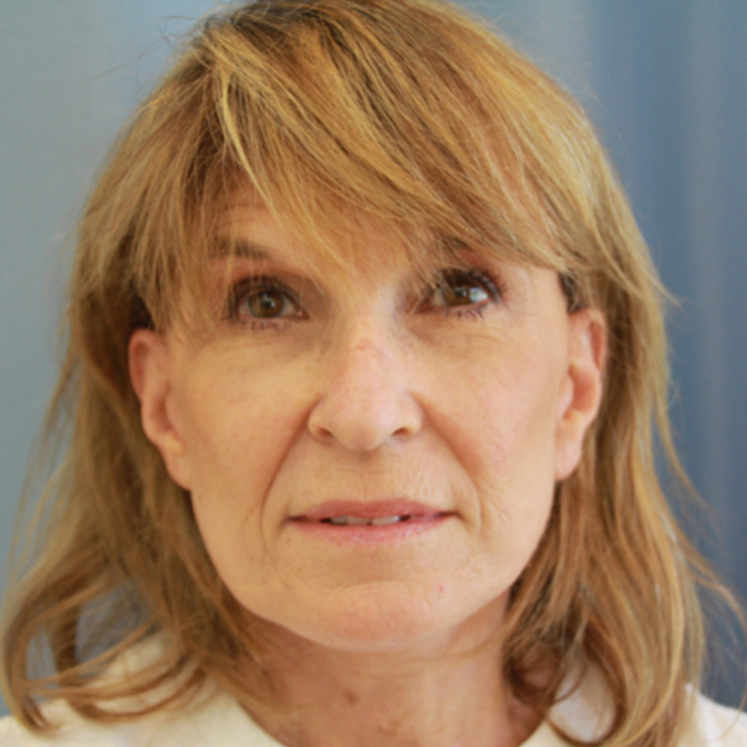 Facelift Before and After | Dr. Leslie Stevens