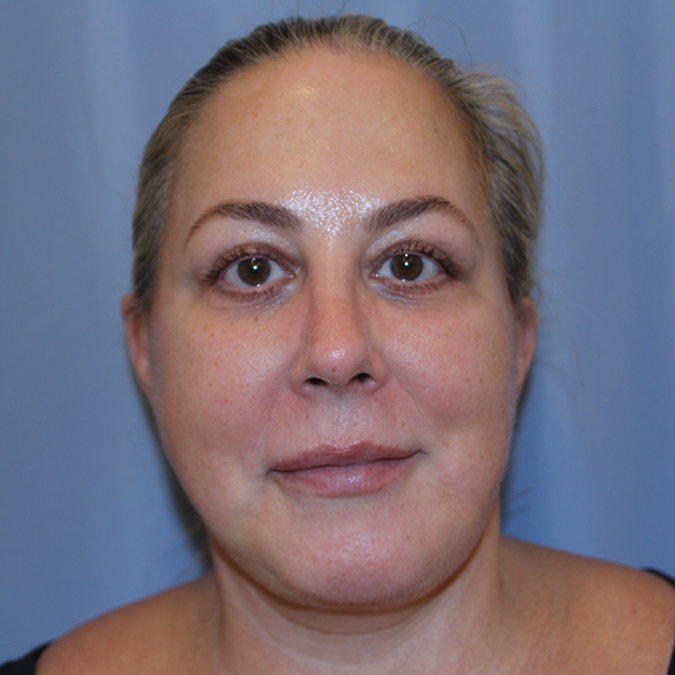 Facelift Before and After | Dr. Leslie Stevens