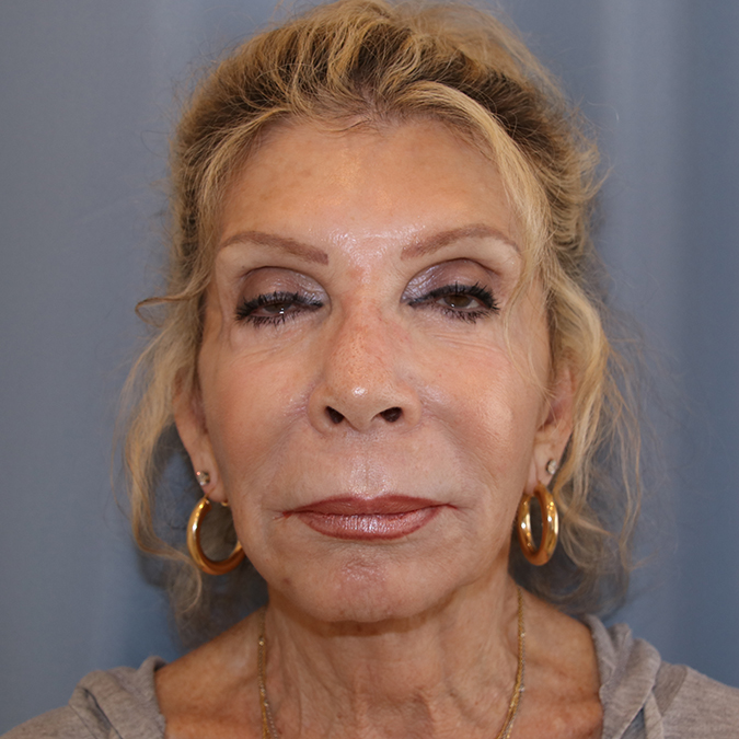 Facelift Before and After 37