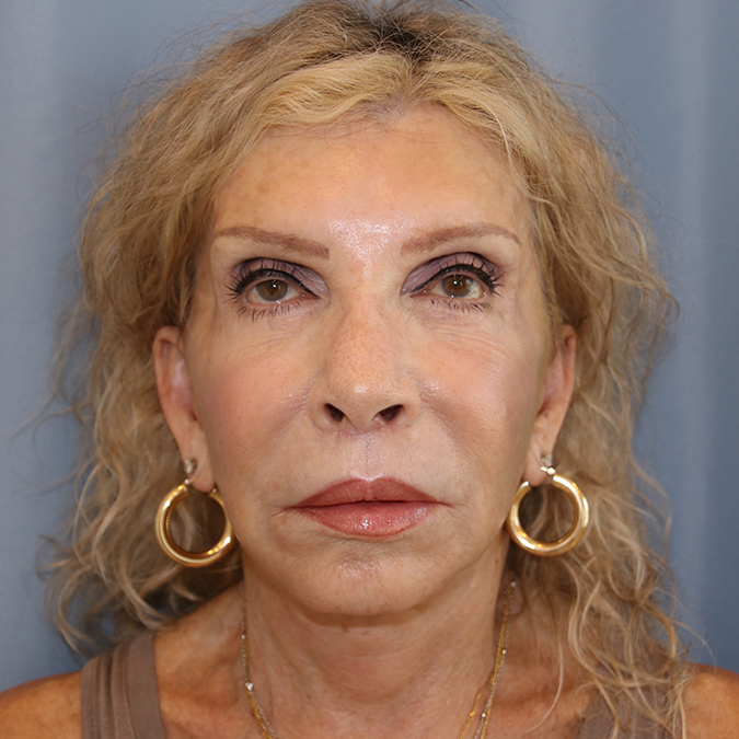 Facelift Before and After 22