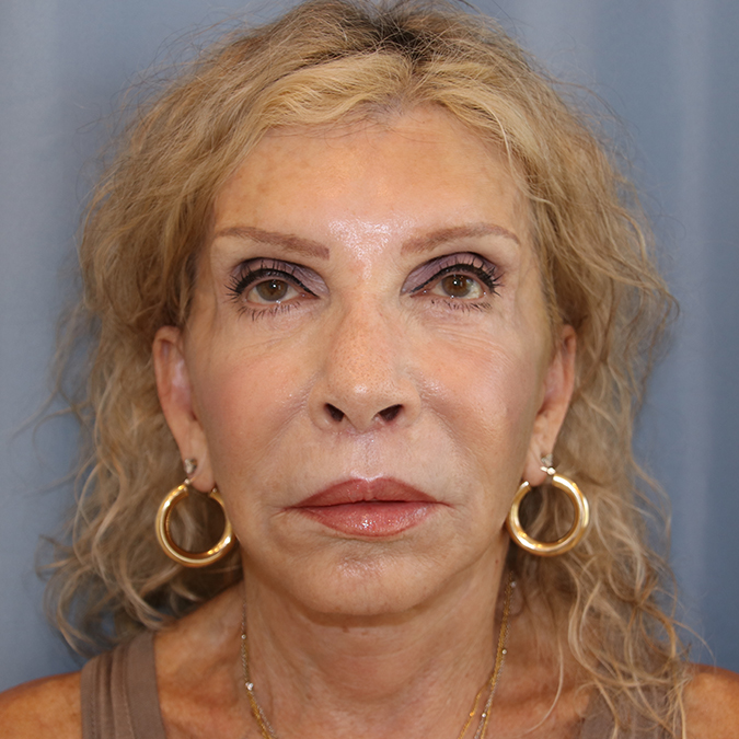 Facelift Before and After | Dr. Leslie Stevens