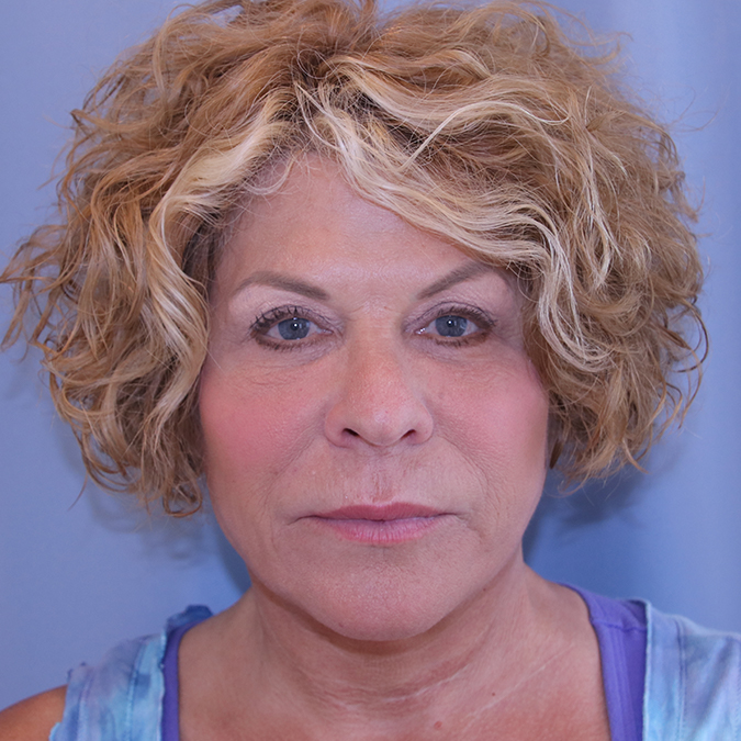 Facelift Before and After | Dr. Leslie Stevens