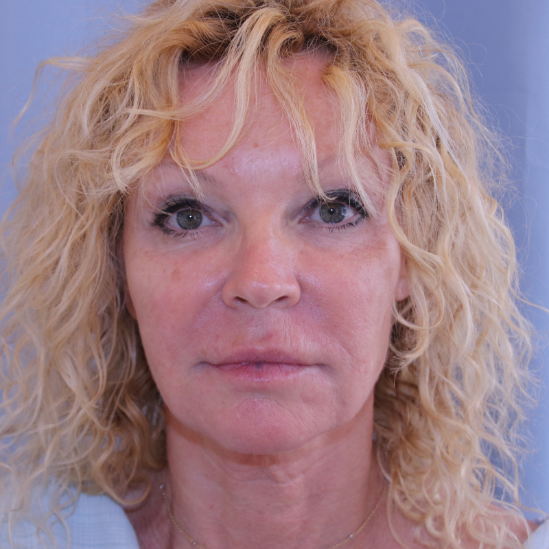 Facelift Before and After | Dr. Leslie Stevens