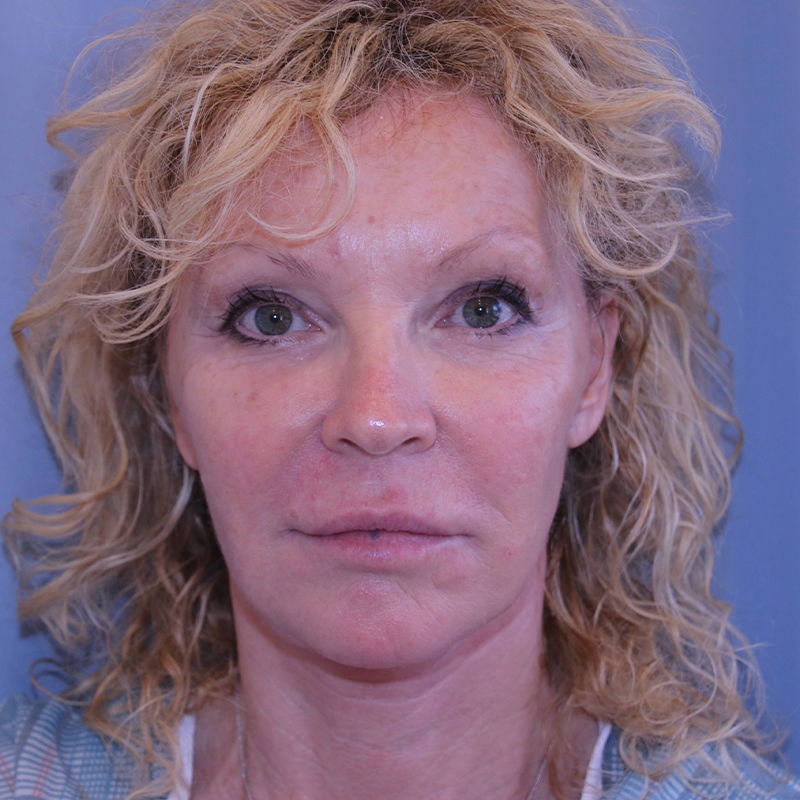 Facelift Before and After 14