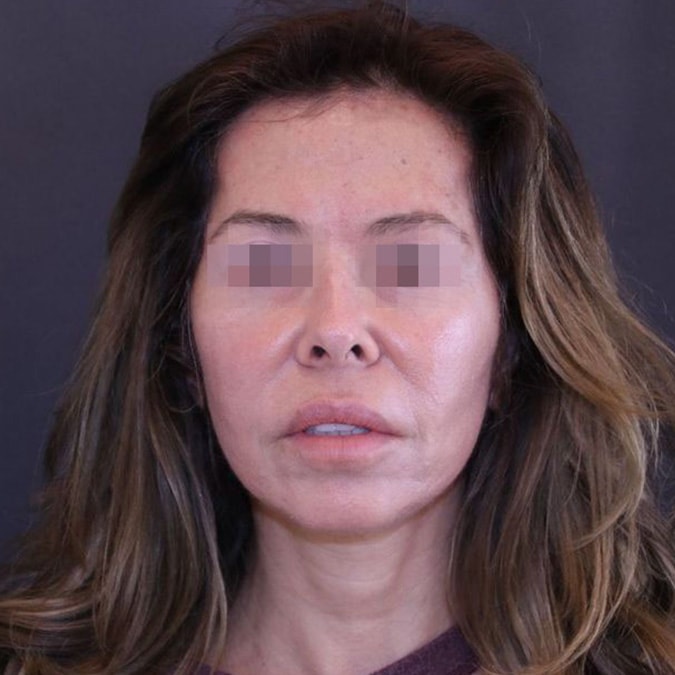 Facelift Before and After | Dr. Leslie Stevens
