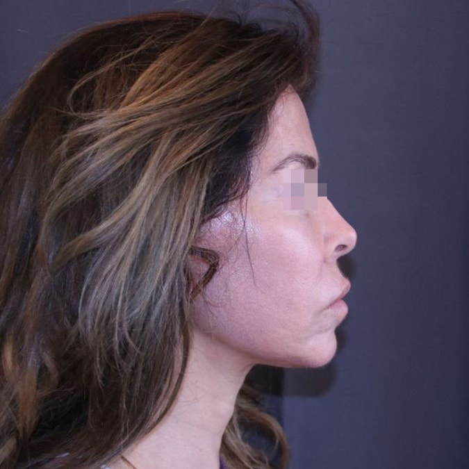 Facelift Before and After 41